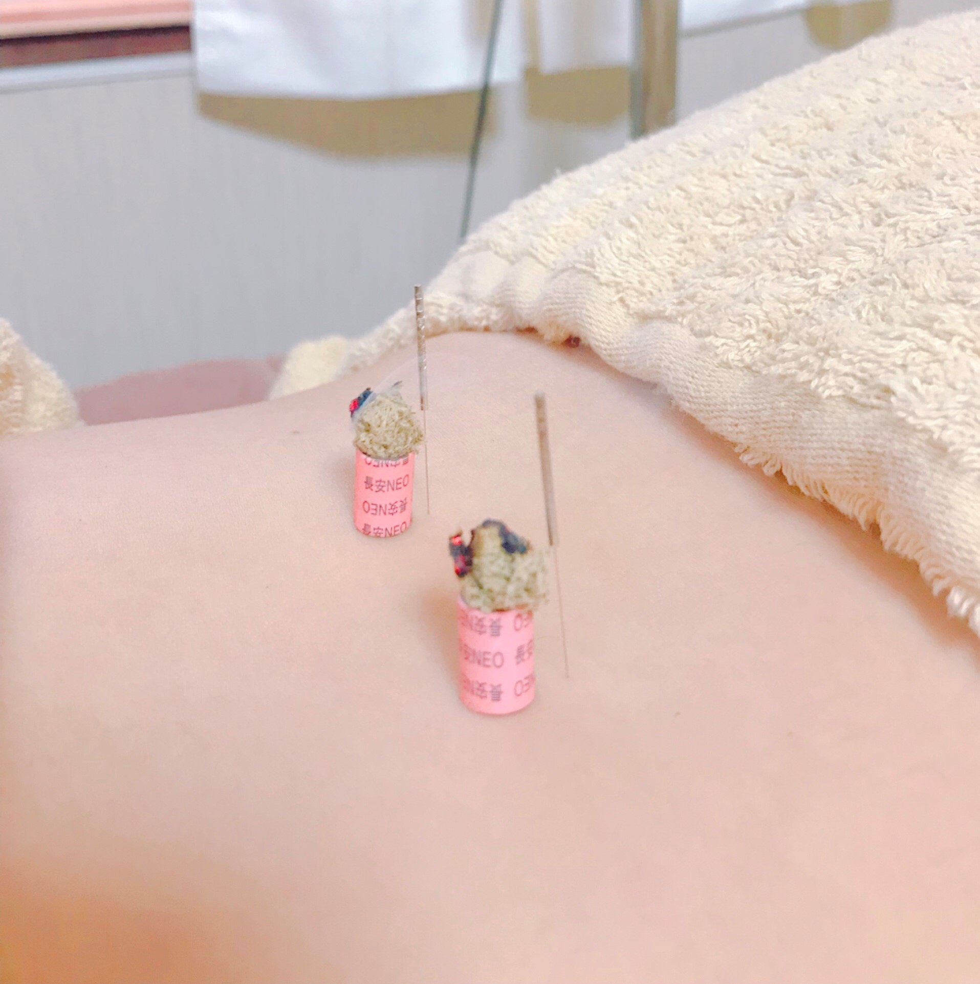 頭痛を予防する鍼灸の方法